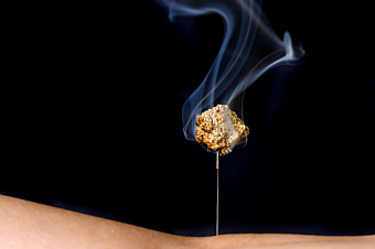 Moxibustion Moxibustion